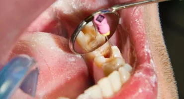 Endolikuvannya pered koronkoyu chy zavzhdy potribno likuvaty kanaly Close-up of a dental procedure: a mirror and instruments are used near a molar in the lower jaw inside the patient’s mouth.