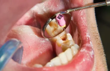 Endolikuvannya pered koronkoyu chy zavzhdy potribno likuvaty kanaly Close-up of a dental procedure: a mirror and instruments are used near a molar in the lower jaw inside the patient’s mouth.