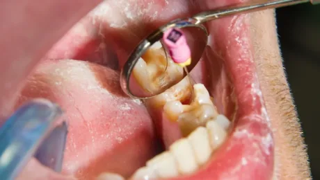 Close-up of a dental procedure: a mirror and instruments are used near a molar in the lower jaw inside the patient’s mouth.