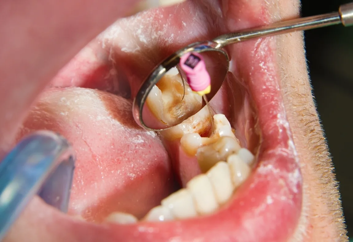 Endolikuvannya pered koronkoyu chy zavzhdy potribno likuvaty kanaly Close-up of a dental procedure: a mirror and instruments are used near a molar in the lower jaw inside the patient’s mouth.