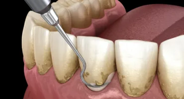 3D illustration of a dental scaler removing tartar from lower front teeth at the gumline.