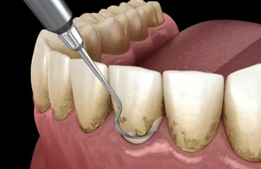 3D illustration of a dental scaler removing tartar from lower front teeth at the gumline.