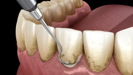 3D illustration of a dental scaler removing tartar from lower front teeth at the gumline.