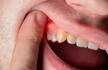 Svyshch na yasnakh chomu zyavlyayetsya i chomu antybiotyk ne vyrishuye problemu