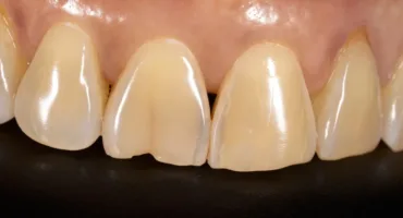 Trishchyna zuba yak vidriznyty vid kariyesu ta koly potribna koronka Close-up of upper front teeth showing a small gap between the central incisors (diastema).