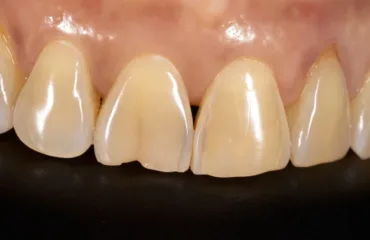 Close-up of upper front teeth showing a small gap between the central incisors (diastema).