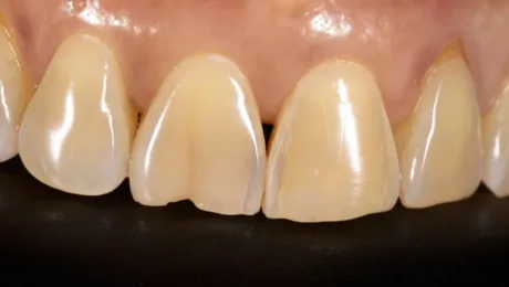 Close-up of upper front teeth showing a small gap between the central incisors (diastema).